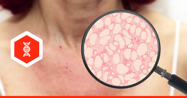 Shining a Light on Skin Cancer