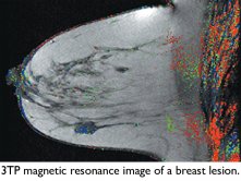 Breast MRI Breast MRI