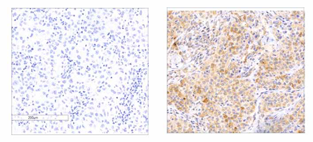 melanoma tumors melanoma tumors