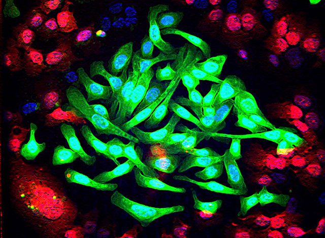 lung cancer cells lung cancer cells