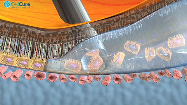 OpRegen Injection into Degerating Retina OpRegen Injection into Degerating Retina