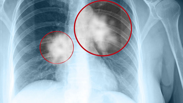 triple treatment for lung cancer triple treatment for lung cancer