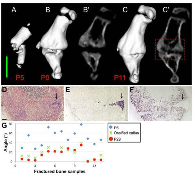 Bone Fractures Bone Fractures