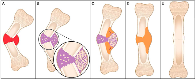 Bone Fracture Diagram Bone Fracture Diagram