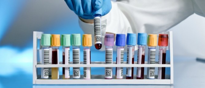 Blood Test for Alzheimers