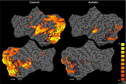 Autism-Research-at-the-Weizmann-Institute-of-Science2 autistic brain (right) shows massive disruption in responses to the external world