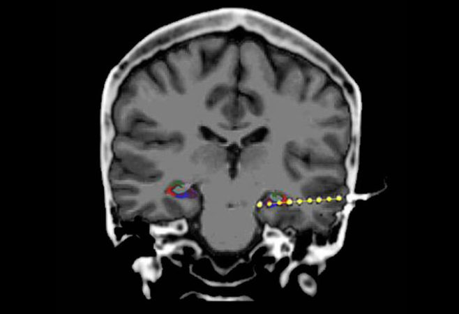 Brain ‘Ripples’ Appear Just Before You Remember Something