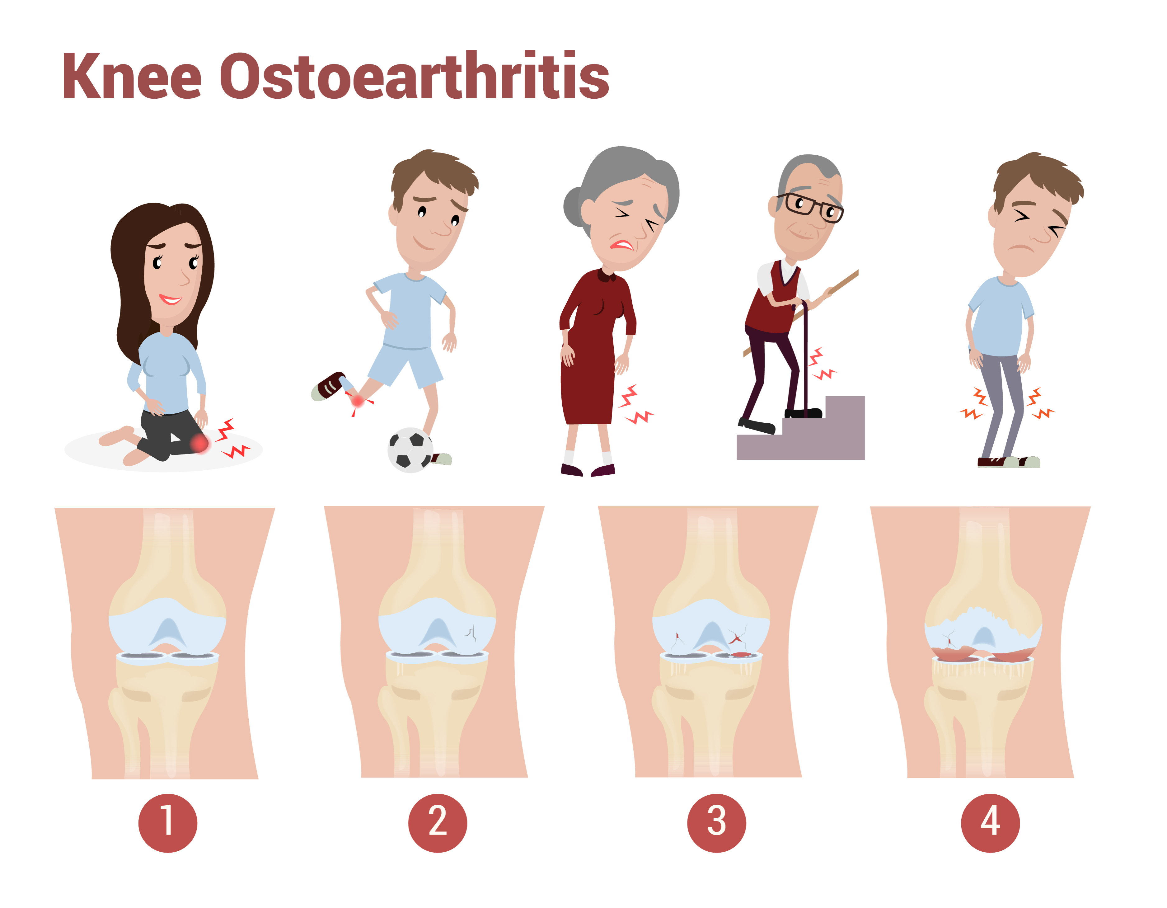 Blog 49 Shutterstock 1138568372 Stages Of Knee OA