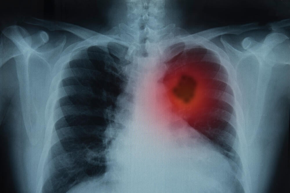 Israeli study finds biological treatment effective for lung cancer